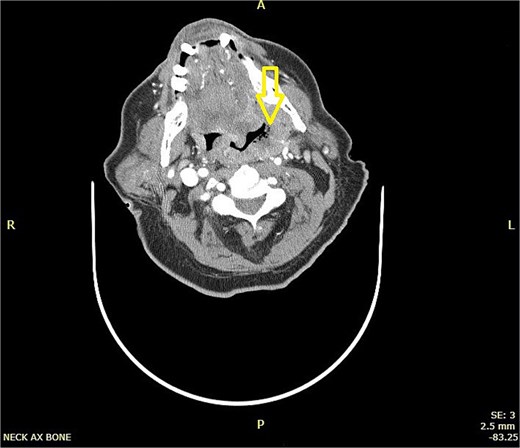 CT scan of neck showing a hyper-dense lesion in the tail of the right parotid gland measuring 1.3 × 0.9 cm (AP, TV dimensions) with no deep extension. The left tonsil is enlarged with faint, il-defined rim enhancement, and central air foci, indicating early abscess formation.