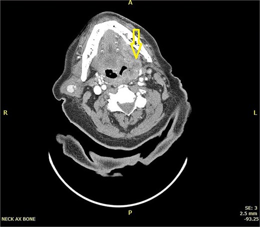 CT scan of neck showing a hyper-dense lesion in the tail of the right parotid gland measuring 1.3 × 0.9 cm (AP, TV dimensions) with no deep extension. The left tonsil is enlarged with faint, il-defined rim enhancement, and central air foci, indicating early abscess formation.