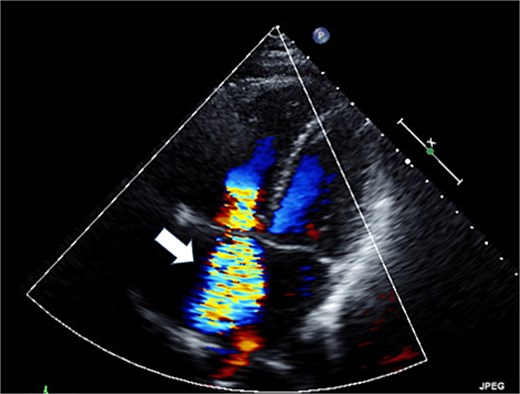 Preoperative transthoracic echocardiography: severe tricuspid regurgitation. The regurgitant jet is indicated by the white arrow.