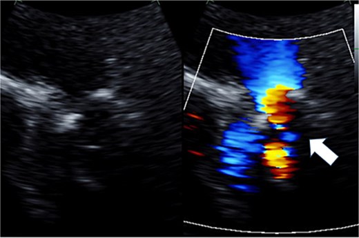 Preoperative transthoracic echocardiography: moderate pulmonary regurgitation. The regurgitant jet is indicated by the white arrow.