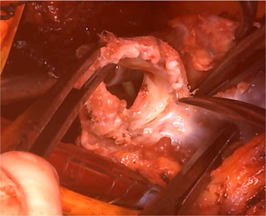 Intraoperative view: the pulmonary artery and right ventricular outflow tract opened with the previously implanted pulmonary valve explanted.