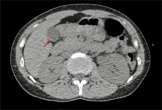 Non-contrast CT scan of the abdomen. The axial plane shows focal thickening of the gallbladder wall (arrow).