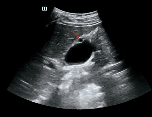 Abdominal ultrasound showed a well-defined, round, anechoic lesion within the gallbladder wall, measuring about 7 mm, likely representing a foregut cyst of the gallbladder. There was no peri-cholecystic edema, obvious shadowing stones, or increased wall thickness.