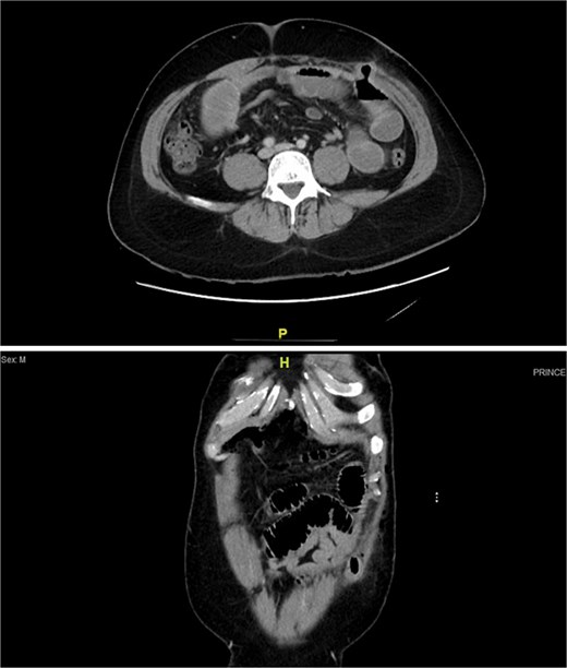 Contrast-enhanced CT scan showing dilated small bowel loops with multiple air–fluid levels, consistent with small bowel obstruction. No clear transition point is identified.