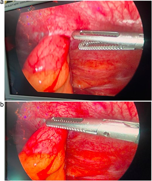 Intraoperative laparoscopic view demonstrating herniation of viable small bowel through the left lower quadrant port-site defect.