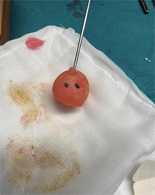 Intraoperative photograph showing the plastic doll just after extraction.