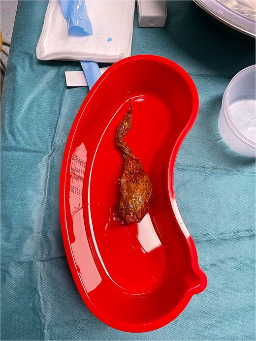 Intraoperative photograph of the retrieved folded plastic bag causing distal ileal obstruction.