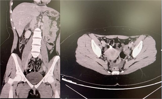 CT abdomen revealed the metallic nail in the cecum.