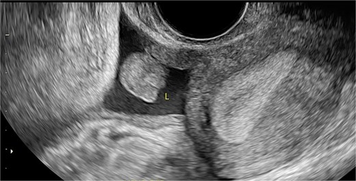 Sagittal transvaginal ultrasound showing free fluid in the uterine fundus.