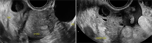 Transverse transvaginal ultrasound demonstrating a 4.7 cm bilocular cyst in the left ovary and a dominant follicle in the right ovary, with moderate periovarian fluid adjacent to the right ovary.