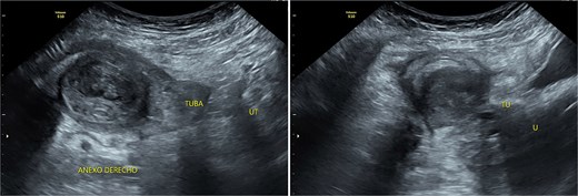 Transpelvic ultrasound reveals a heterogeneous mass adjacent to the right adnexa measuring 4.6 × 8.4 cm, predominantly hypoechoic with anechoic areas.