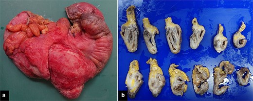 Macroscopic findings. (a) Right hemicolectomy specimen, 45 cm in length, showing an irregular brown-violet area with white plaques involving the cecum, appendix, and terminal ileum. (b) Formalin-fixed serial sections reveal a fibrous, whitish-brown lesion aggregating without infiltrating the described regions. The mucosa was preserved on cross-section.