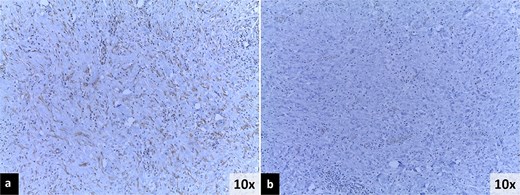Immunohistochemistry findings. (a) Positive immunoreactivity for muscle-specific actin (MSA). (b) Negative immunoreactivity for anaplastic lymphoma kinase (ALK).