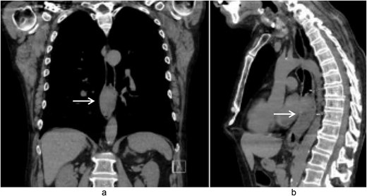Coronal (a) and sagittal (b) views of the initial CT scan at time of presentation that revealed a large esophageal mass with concern for complete obstruction (arrows).