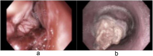 Endoscopic images (a and b) of a nearly obstructive intraluminal esophageal mass.