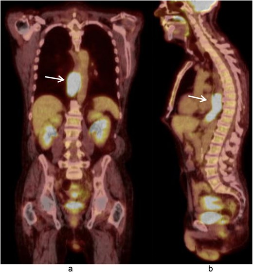Coronal (a) and sagittal (b) views of the PET scan showing area of hypermetabolic activity at the lower esophagus without evidence of distant disease (arrows).