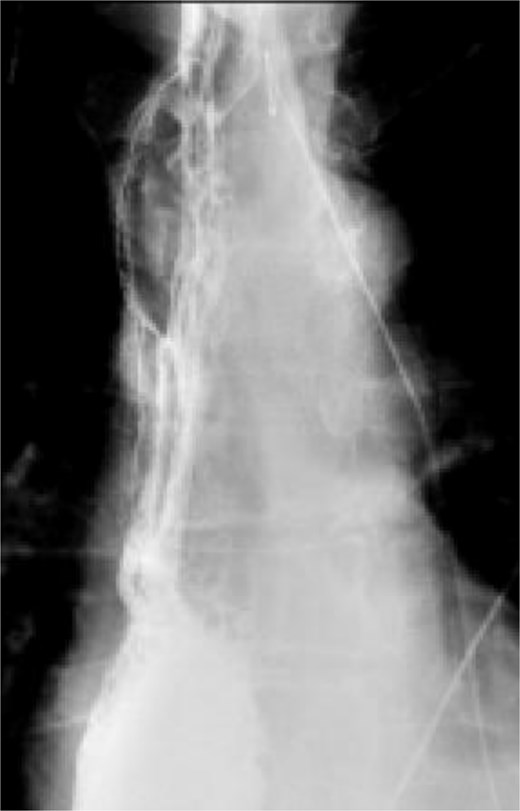 Fluoroscopic esophagram showing an intact anastomosis without contrast extravasation on postoperative day 6 status post-esophagectomy.