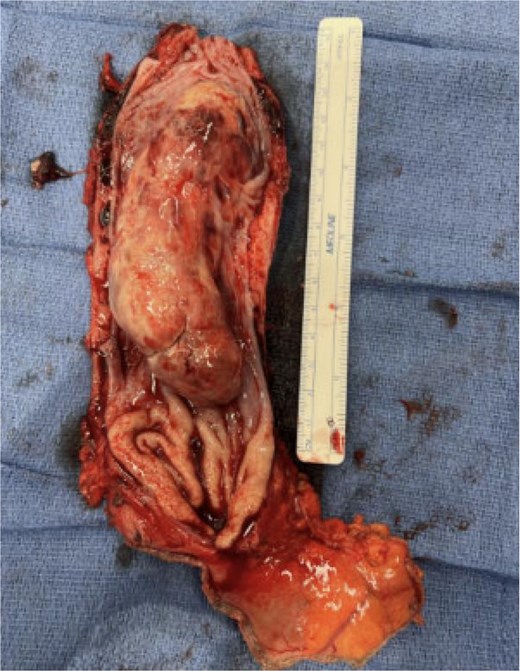 Gross specimen of esophageal mass.