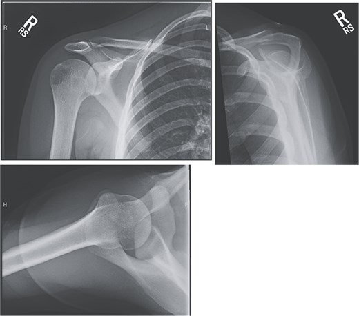 Radiographic imaging on initial presentation was without transverse scapular ligament calcification.