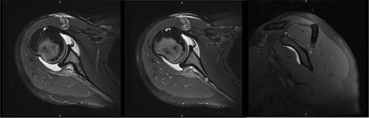 Initial MRI arthrogram revealed low-grade undersurface fraying of the supraspinatus and infraspinatus tendons consistent with internal impingement, hypertrophic posterior inferior labrum without visible tearing, and no evidence of paralabral cyst.