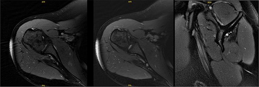 MRI 6 years after decompression revealed a diffusely atrophic infraspinatus muscle belly.