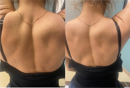 Nine and half years after decompression, the patient presented with palpable and visible atrophy of the right infraspinatus.