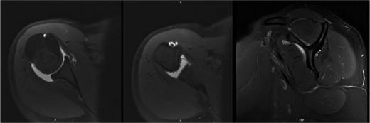 MRI at 9.5 years after decompression demonstrated increased right infraspinatus muscular tissue.