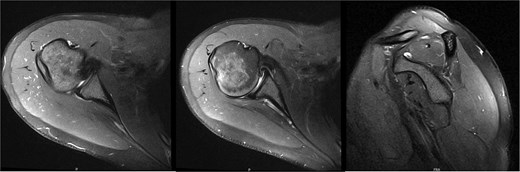MRI at final follow-up demonstrated mild supraspinatus tendinosis, and infraspinatus atrophy with continued significant fatty infiltration, unchanged from prior imaging.