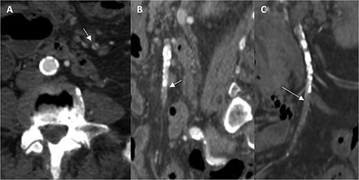 Computed tomography angiography images demonstrating occlusion of the superior mesenteric artery in the axial (A), sagittal (B), and coronal planes (C; arrows indicating the thrombus).
