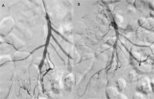 Angiographic images before (A) and after (B) thrombectomy of the superior mesenteric artery (SMA).