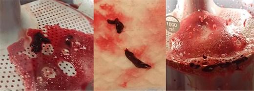 Images of the thrombus retrieved using the Penumbra® system.