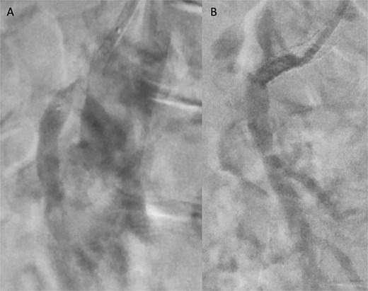 Angiographic images before (A) and after (B) primary stenting of SMA ostium using a 6 × 39 mm Advanta® stent with proximal flare.