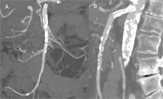 Pre-discharge follow-up CTA showing patent SMA and no complications, with coronal (A) and sagittal (B) images.