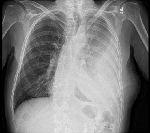 Initial chest radiograph showing a large loculated left sided pleural effusion.