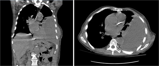 Coronal (left) and axial (right) view CT scan of the chest showing a large complex loculated left pleural effusion with bulging into the chest wall, raising concern for empyema necessitans.