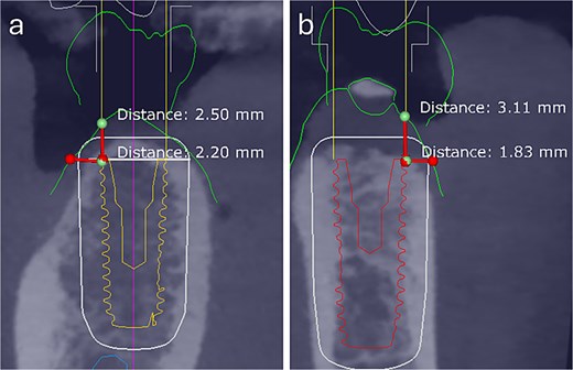 Preoperative digital assessment of buccal soft and hard tissue thickness using cross-sectional CBCT planning views. The measured distances represent the combined buccal bone and mucosal thickness from the buccal crest of the planned implant to the external surface of the mucosa. (a) Case 1: Total mid-buccal tissue thickness ≈ 2.20 mm; vertical thickness ≈ 2.50 mm. (b) Case 2: Total mid-buccal tissue thickness ≈ 1.83 mm; vertical thickness ≈ 3.11 mm.