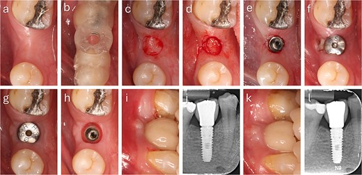 Step-by-step clinical sequence of buccal soft tissue augmentation with deepithelialized punched tissue during delayed loading implant placement. The graft demonstrated stable integration and enhanced buccal mucosal volume at follow-up. (a) Preoperative occlusal view. (b) Surgical guide in position. (c) Exposure of keratinized tissue. (d) Removal of punched tissue. (e) Implant placement. (f) Graft positioned in buccal pouch. (g) Two-month follow-up showing improved buccal contour. (h) Mucosa after tissue former removal. (i) Final crown at two months. (j) Radiograph at two months. (k) Six-month follow-up with stable peri-implant mucosa. (l) Radiograph at six months showing marginal bone remodeling.