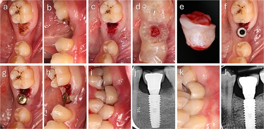 Clinical sequence of buccal augmentation with deepithelialized punched tissue during immediate implant loading. The graft was incorporated successfully, with stable peri-implant tissues at six months. (a, b) Preoperative occlusal and lateral views with atrophic ridge and retained root. (c) Occlusal view after extraction. (d) Surgical guide in position. (e) Harvested keratinized punched tissue. (f) Scan body placement. (g, h) Graft insertion and tissue former placement. (i) Crown delivered at 48 hours. (j) Radiograph after crown placement. (k) Six-month follow-up with healthy peri-implant mucosa. (l) Radiograph at 6 months showing no bone loss.