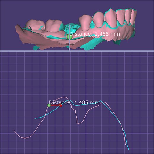 Quantitative digital evaluation of buccal mucosal thickness before and after graft healing. Superimposed STL models show the pre-grafting surface and the 2-month postoperative surface after alignment in DentalCAD 3.1 (exocad, Germany). Linear measurement taken at the widest buccal contour demonstrates an increase in mucosal thickness of ~1.49 mm between the two time points.