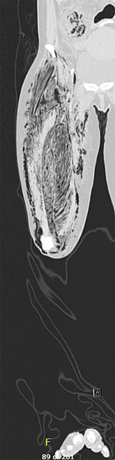 CTA right lower extremity, coronal.