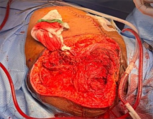 Intra-operative right hip disarticulation.