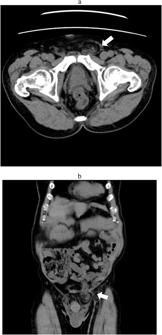 Abdominal computed tomography showing a recurrent left inguinal hernia (arrows) containing omental tissue. (a) Axial view. (b) Coronal view.
