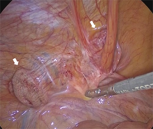 Laparoscopic view of the left inguinal region showing two previously placed mesh plugs (arrows). No definite recurrent hernia orifice was identified. Dense adhesions were present around the plugs.