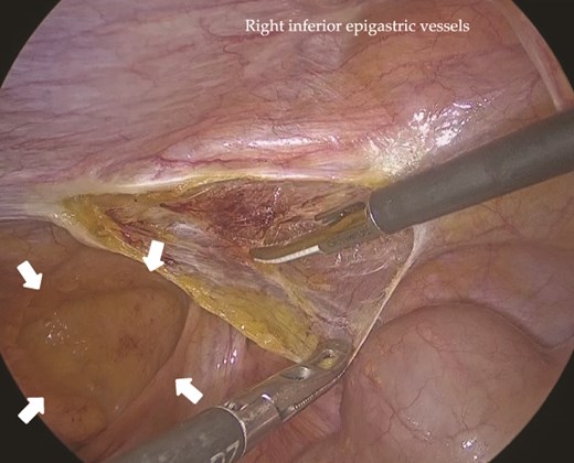Intraoperative view of the right inguinal region before repair. A right indirect inguinal hernia with a defect measuring >30 mm was observed (arrows). A high peritoneal incision was made near the right anterior superior iliac spine.