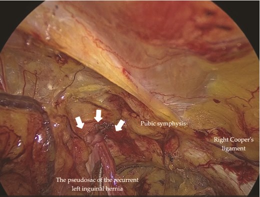 Intraoperative view of the left inguinal region. The recurrent hernia orifice (arrows) and pseudosac were located adjacent to the pubic symphysis. Dense fibrotic adhesions were present around the pseudosac.