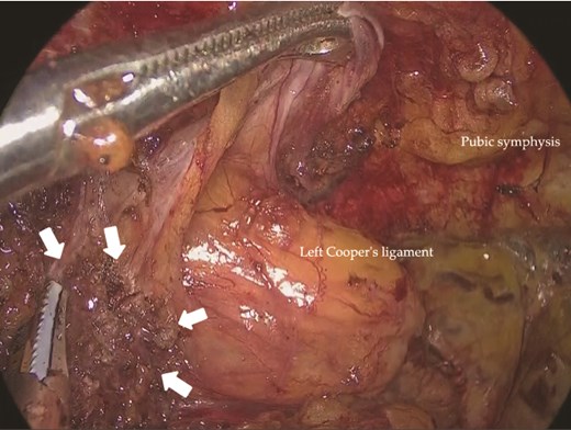 Adhesions between the previously placed mesh (arrows) and the peritoneum in the left inguinal region.