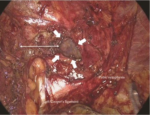 Intraoperative view of the left inguinal region. An R1M2-type recurrent hernia orifice (arrows) was identified adjacent to a mesh plug. A circumferential margin of ~2.5 cm (double-headed arrow) was secured around the defect.