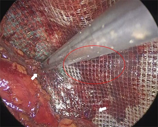 Mesh fixation using a tacker (arrows). The distance from the recurrent hernia orifice (circle) was limited.