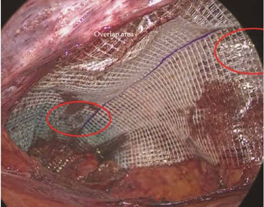 Mesh placed on the left side (circle) and secured with tackers. The right-sided hernia orifice (circle) was fully covered.