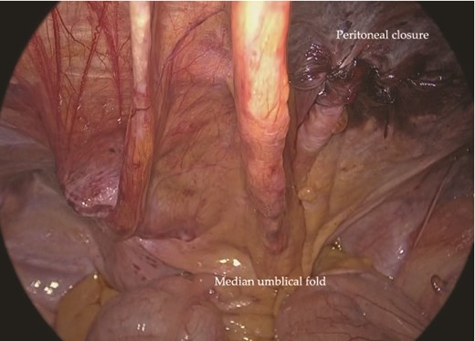 Completed repair of the left recurrent hernia using contralateral high-peritoneal access from the right side.